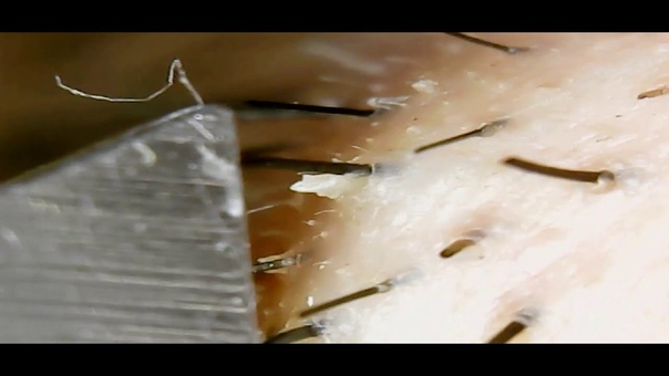 Pulling the hair from his beard with tweezers (удаление бороды
