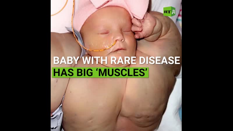 Baby With Rare Disease Has Big Muscles RT