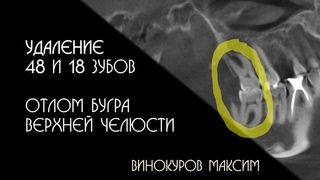 Удаление зубов мудрости и отлом бугра. Максим Винокуров.